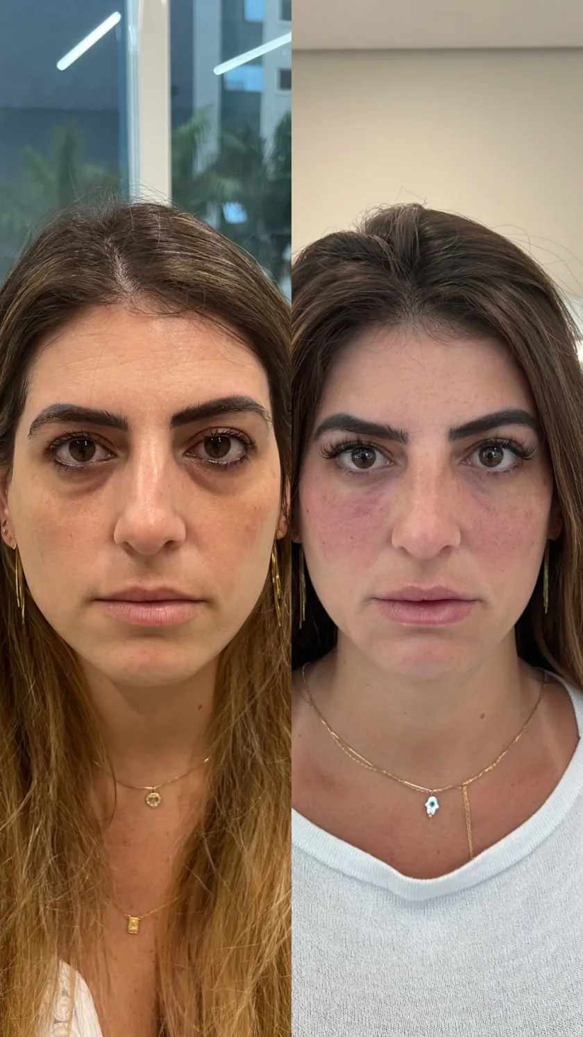 Antes e depois de uma paciente da Faces Naturais, com resultado natural