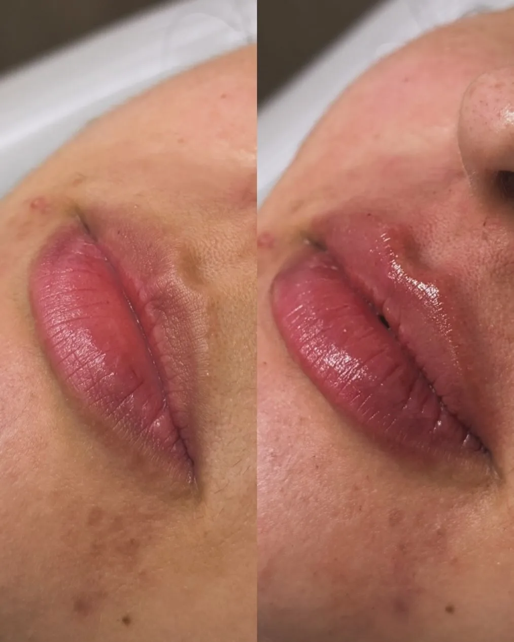 Resultado antes e depois de procedimento nos lábios