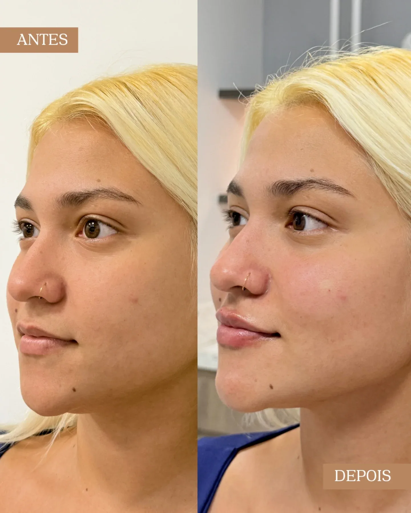 Resultado antes e depois de procedimento facial em visão lateral