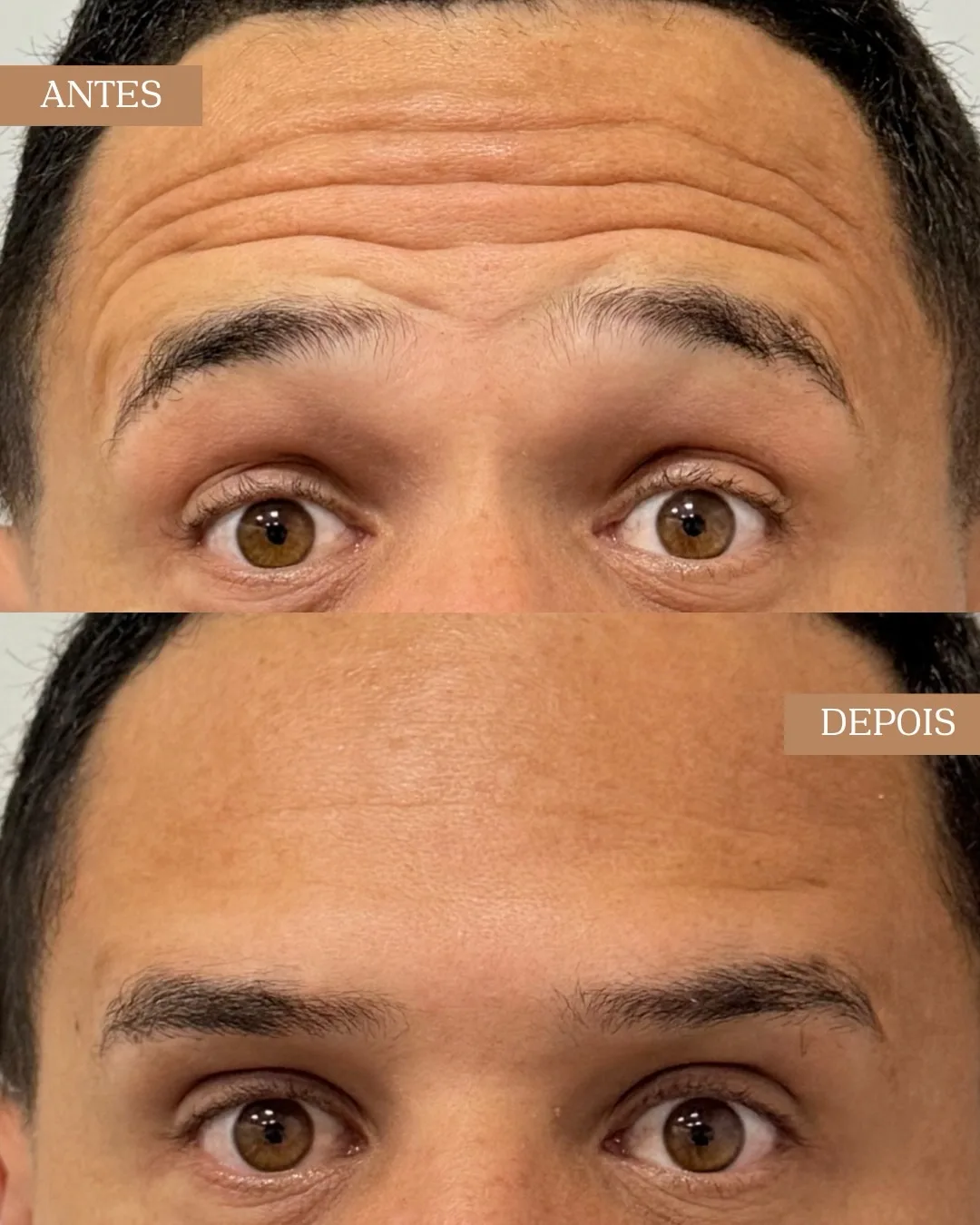 Resultado antes e depois de procedimento na região da testa