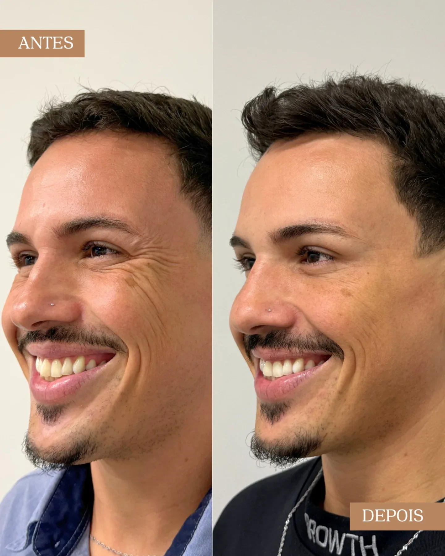 Resultado antes e depois de procedimento facial em paciente homem