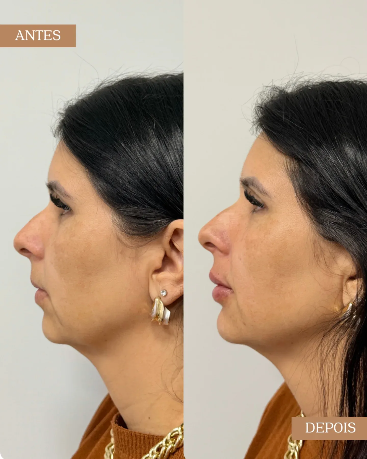 Resultado antes e depois de procedimento facial em visão de perfil