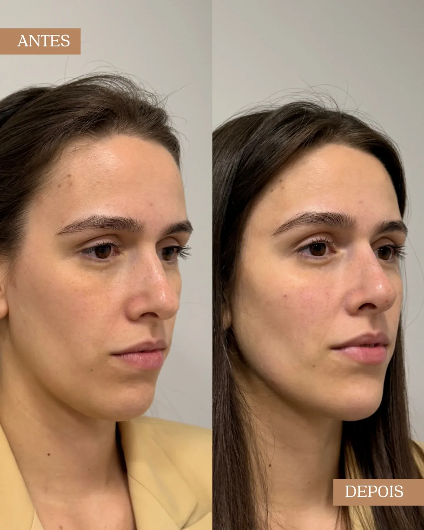 Resultado antes e depois de procedimento facial em visão de perfil