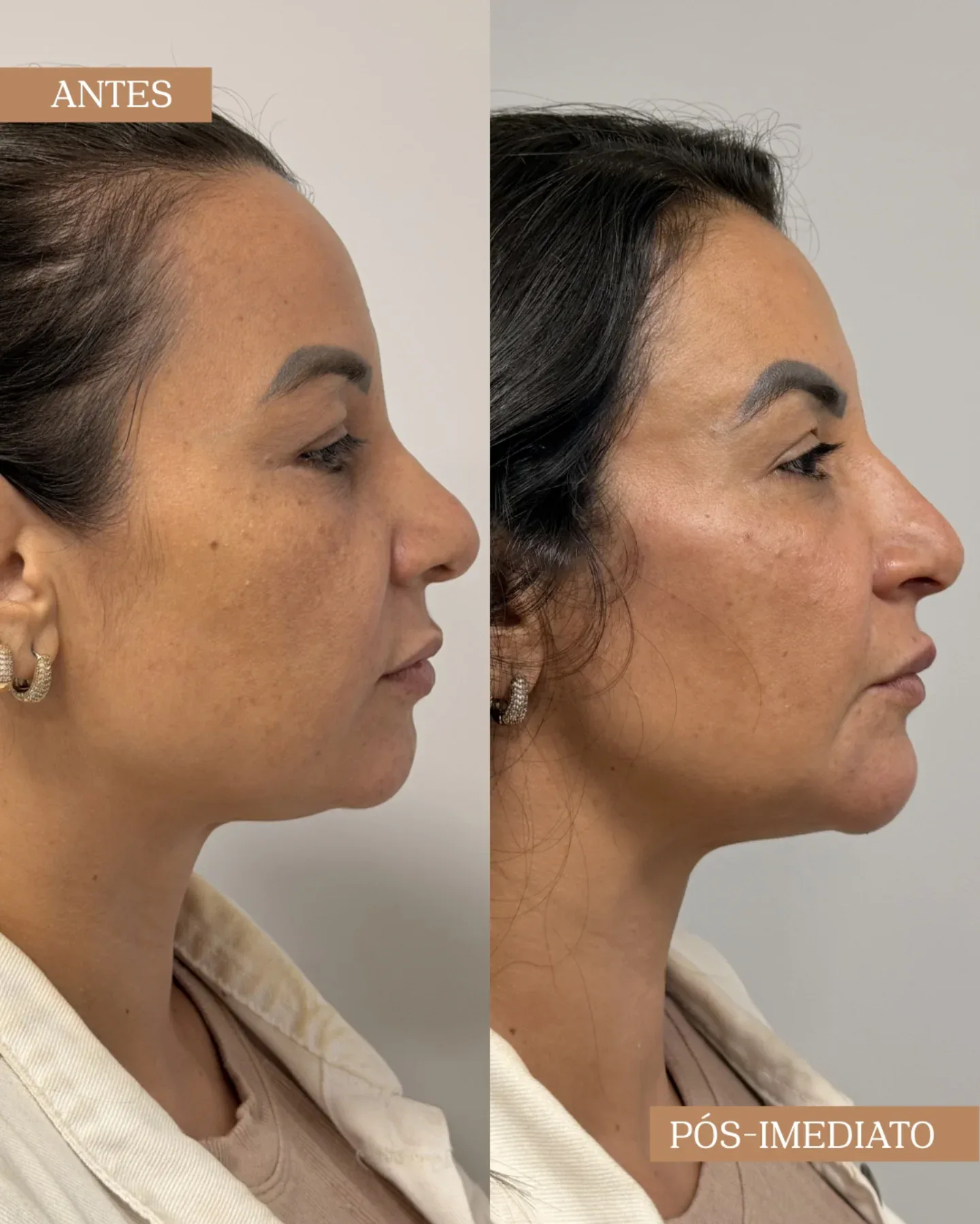 Resultado antes e pós-imediato de procedimento facial em visão de perfil