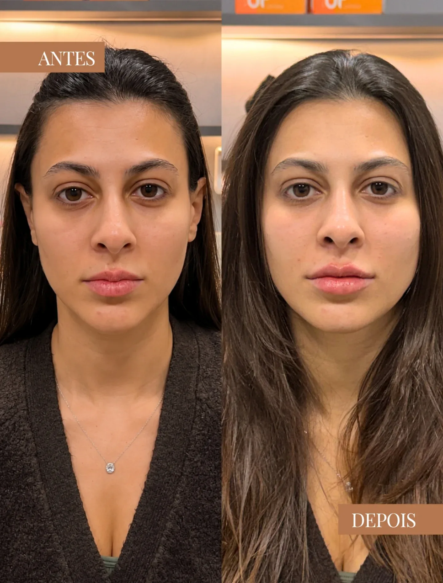 Resultado antes e depois de procedimento facial em visão frontal