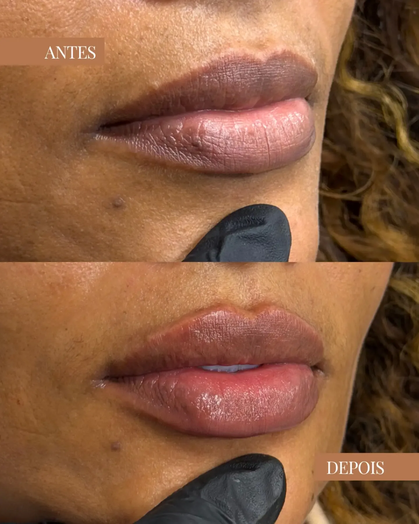 Resultado antes e depois de procedimento nos lábios