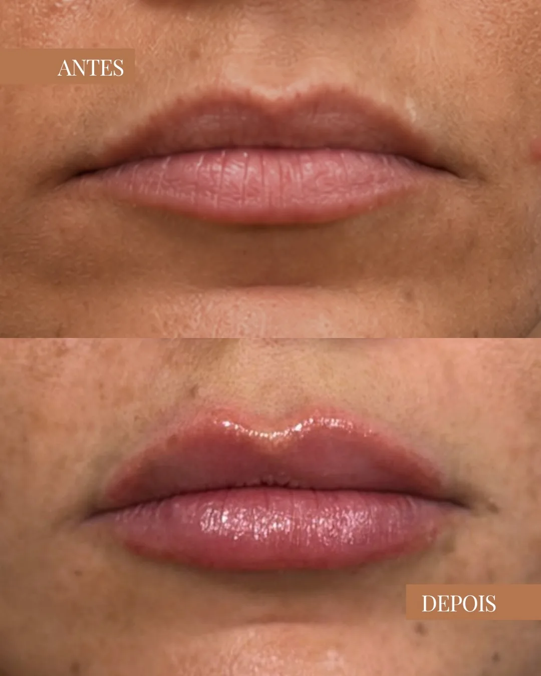 Resultado antes e depois de procedimento nos lábios